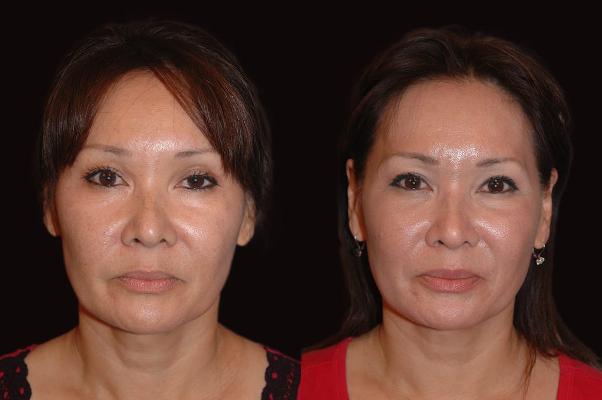Lasers Before & After Gallery - Patient 734759 - Image 5