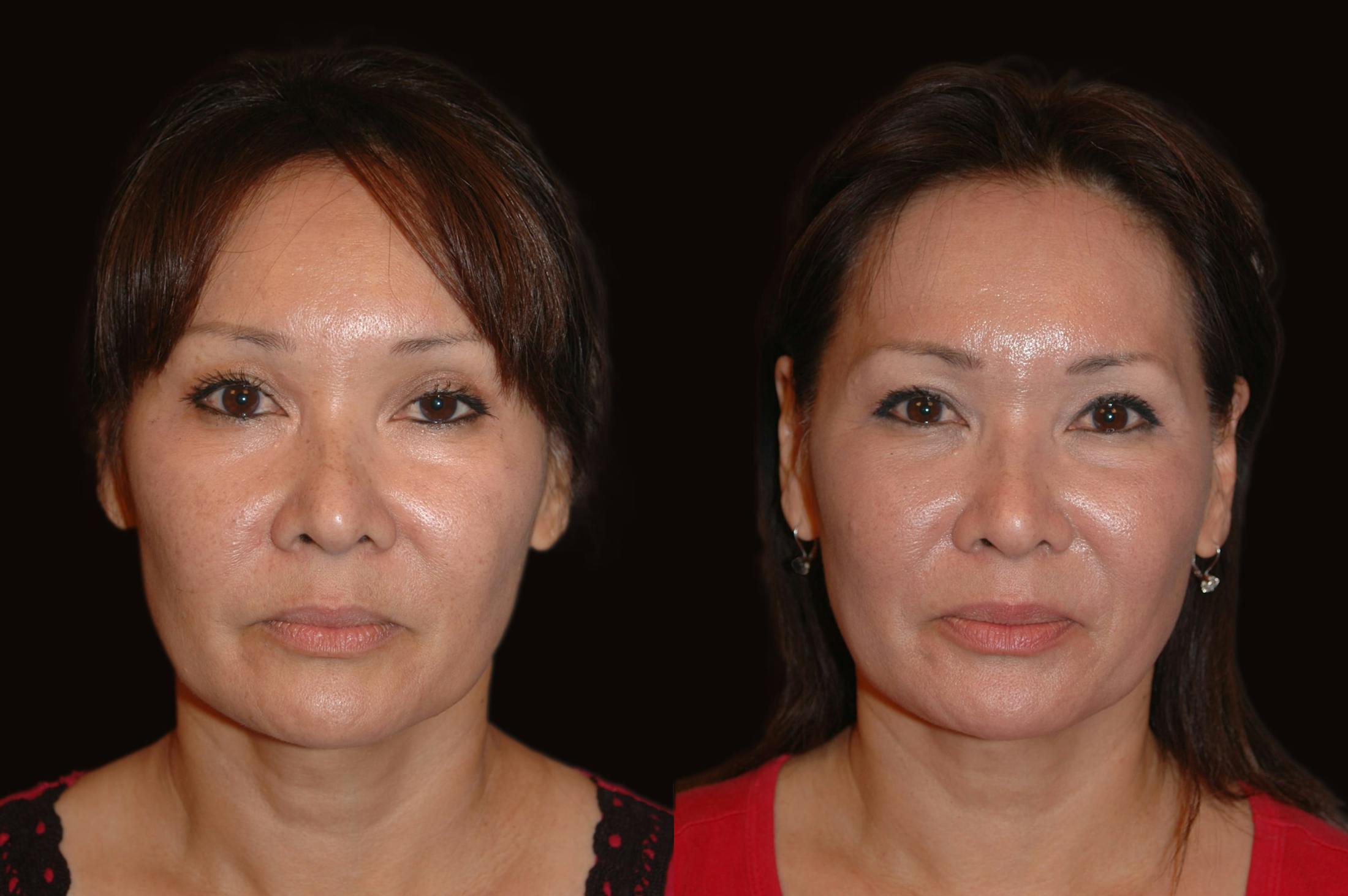 Lasers Before & After Gallery - Patient 734759 - Image 5