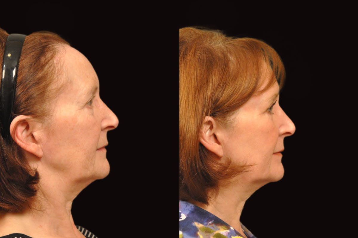 Lasers Before & After Gallery - Patient 213151 - Image 3