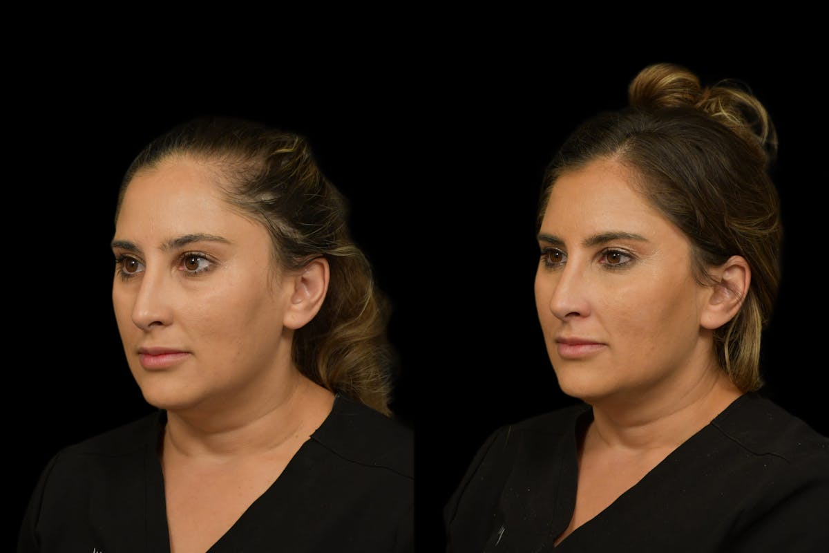Injectables Before & After Gallery - Patient 396162 - Image 3