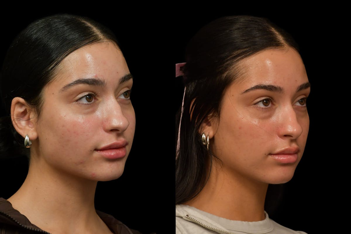 Injectables Before & After Gallery - Patient 333040 - Image 2