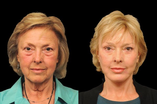 Brow Lift Before & After Gallery - Patient 169528 - Image 1