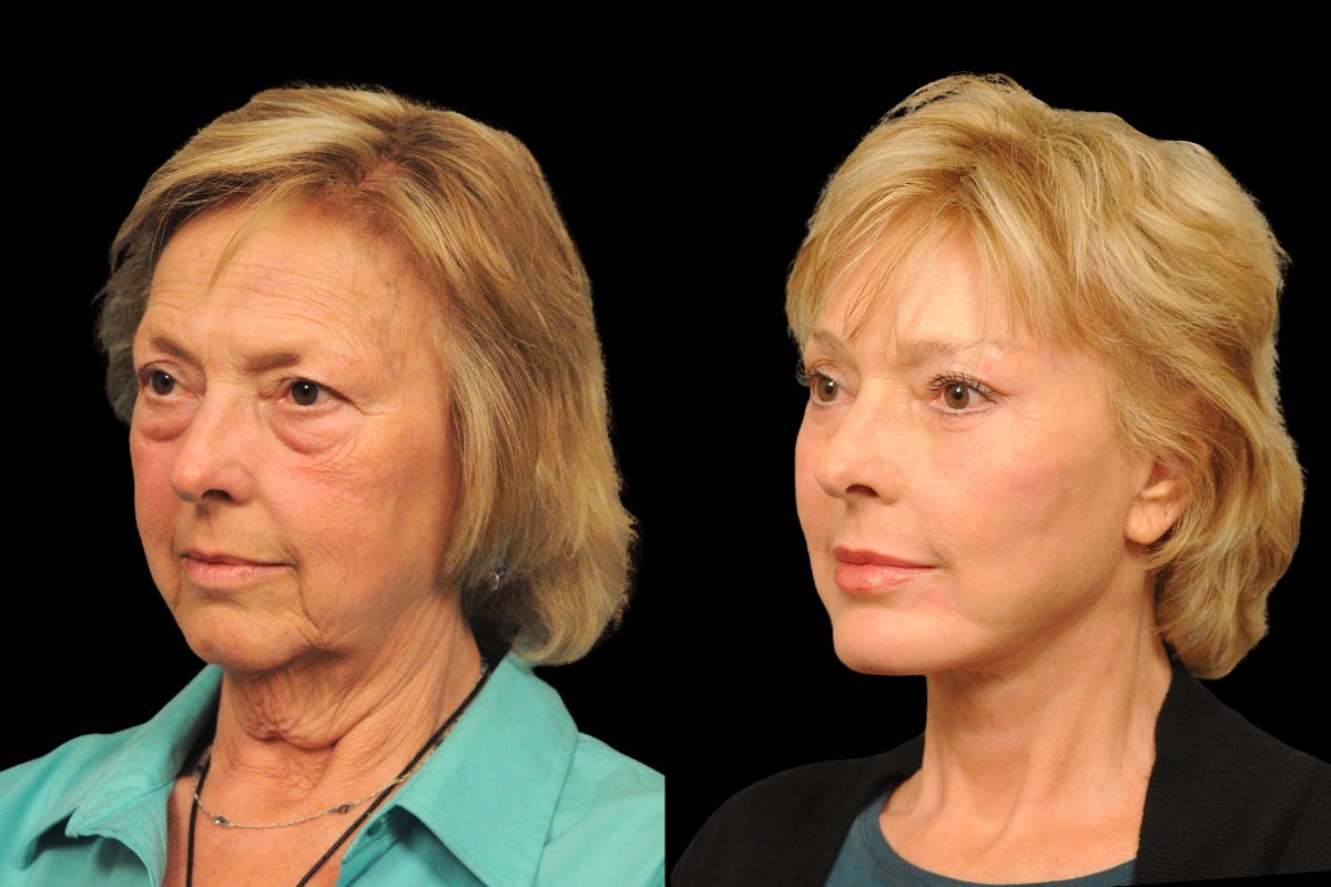 Brow Lift Before & After Gallery - Patient 169528 - Image 2