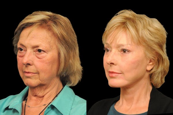Changes Rapid Lift  Before & After Gallery - Patient 238639 - Image 1