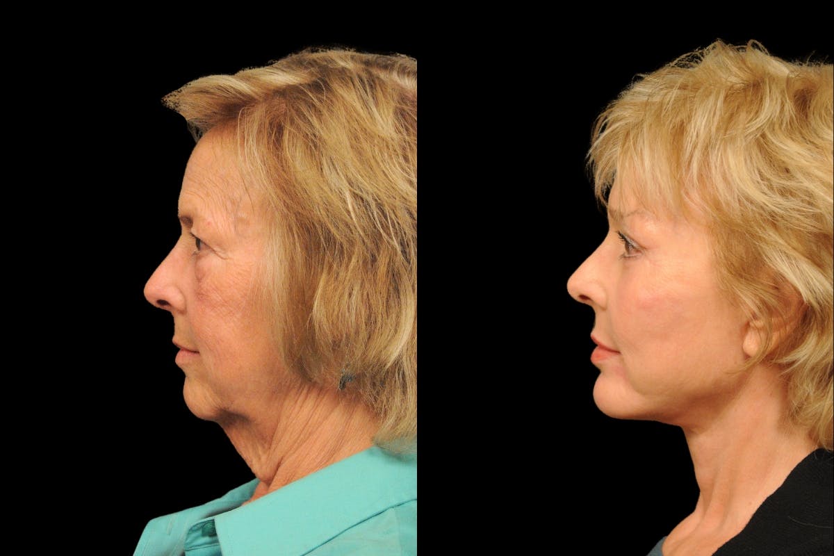 Brow Lift Before & After Gallery - Patient 169528 - Image 3