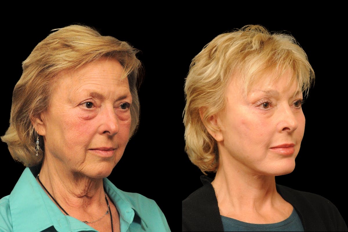 Brow Lift Before & After Gallery - Patient 169528 - Image 4
