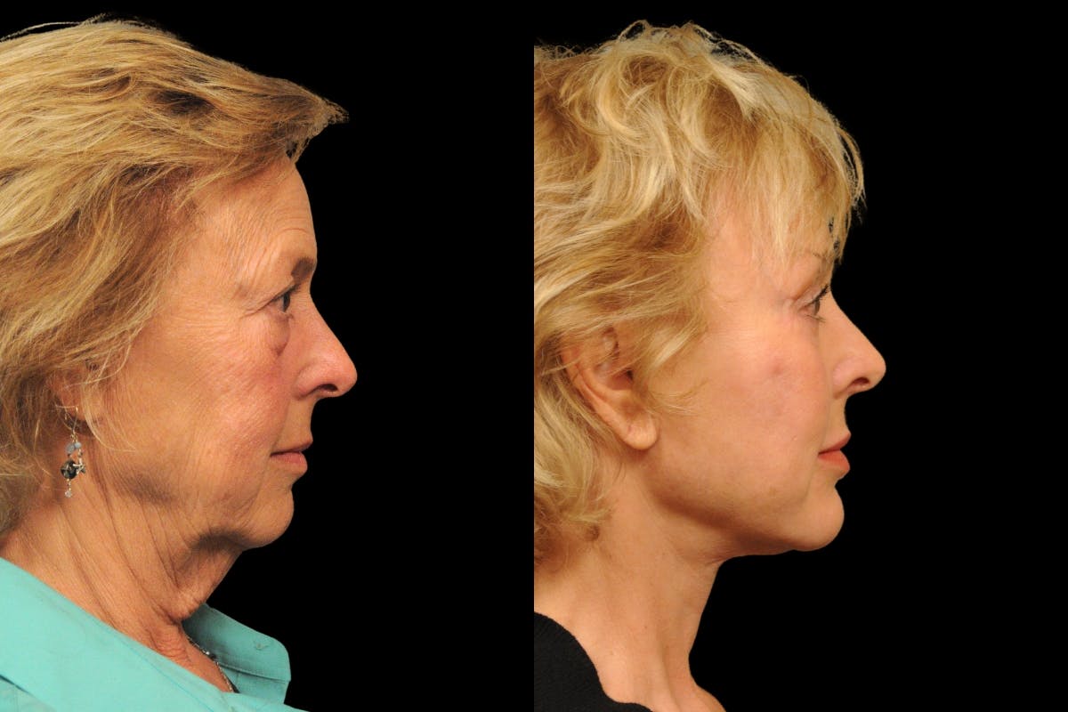 Brow Lift Before & After Gallery - Patient 169528 - Image 5