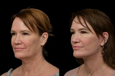 Changes Rapid Lift  Before & After Gallery - Patient 329133 - Image 1