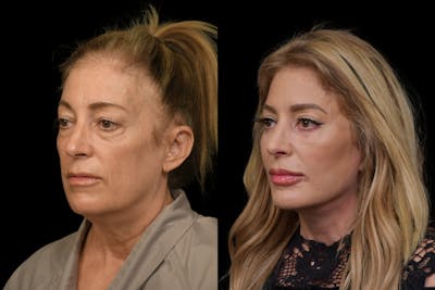 Changes Rapid Lift  Before & After Gallery - Patient 216436 - Image 1
