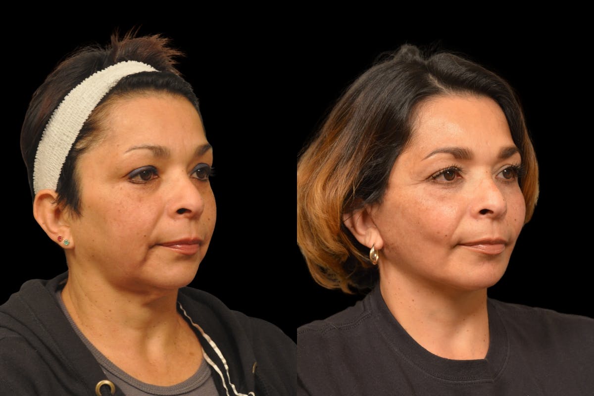 Neck Lift Before & After Gallery - Patient 244418 - Image 3