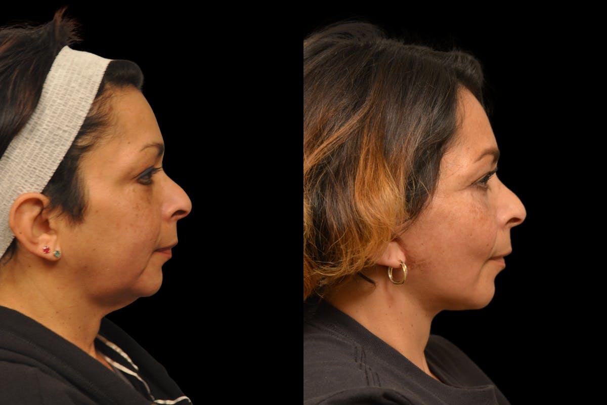 Neck Lift Before & After Gallery - Patient 244418 - Image 4