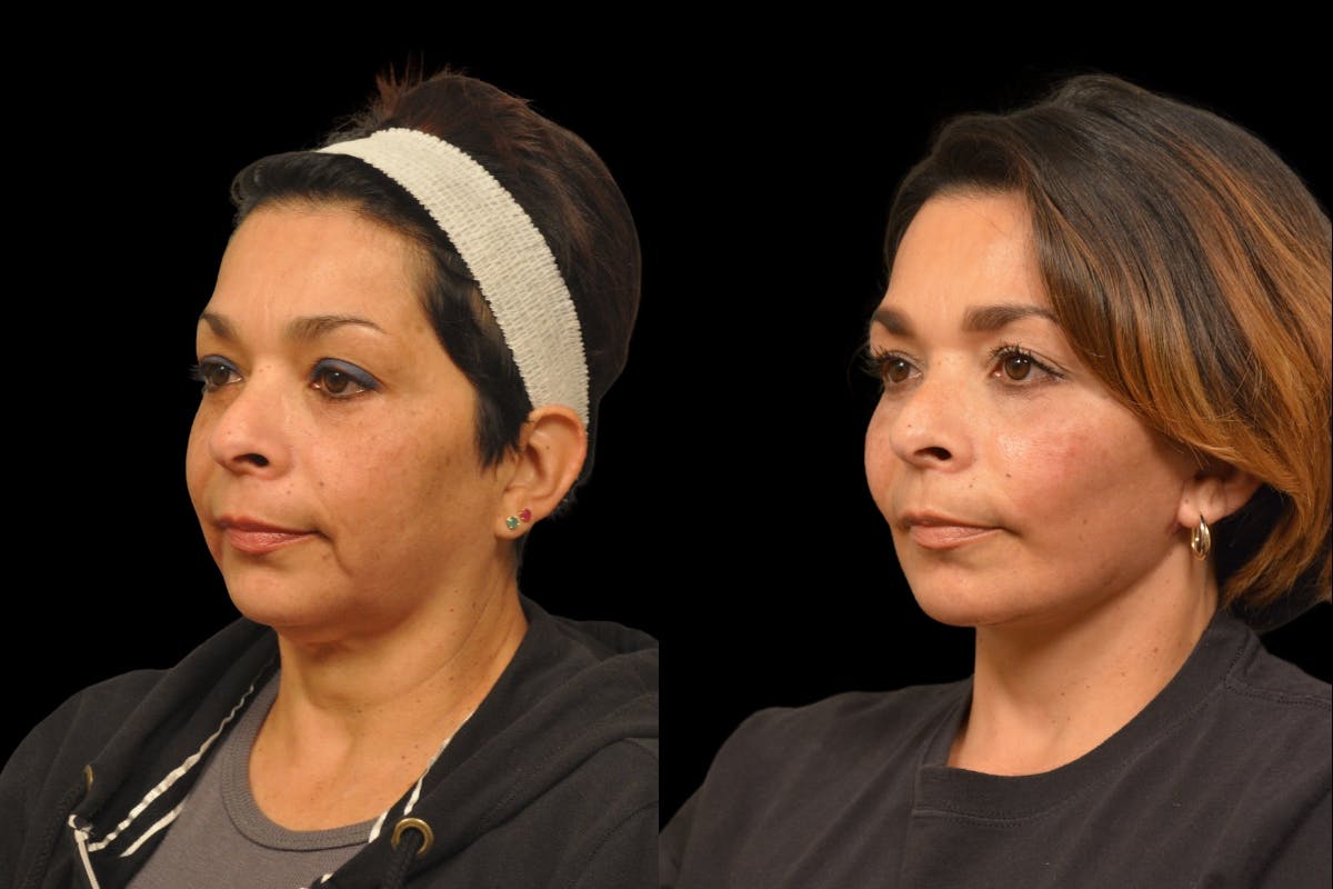 Neck Lift Before & After Gallery - Patient 244418 - Image 1