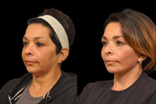 Neck Lift Before & After Gallery - Patient 244418 - Image 1