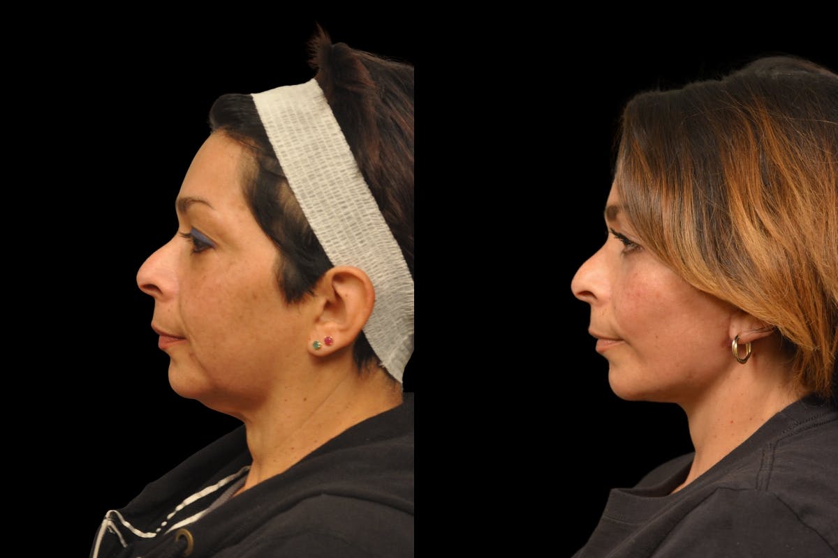 Neck Lift Before & After Gallery - Patient 244418 - Image 5