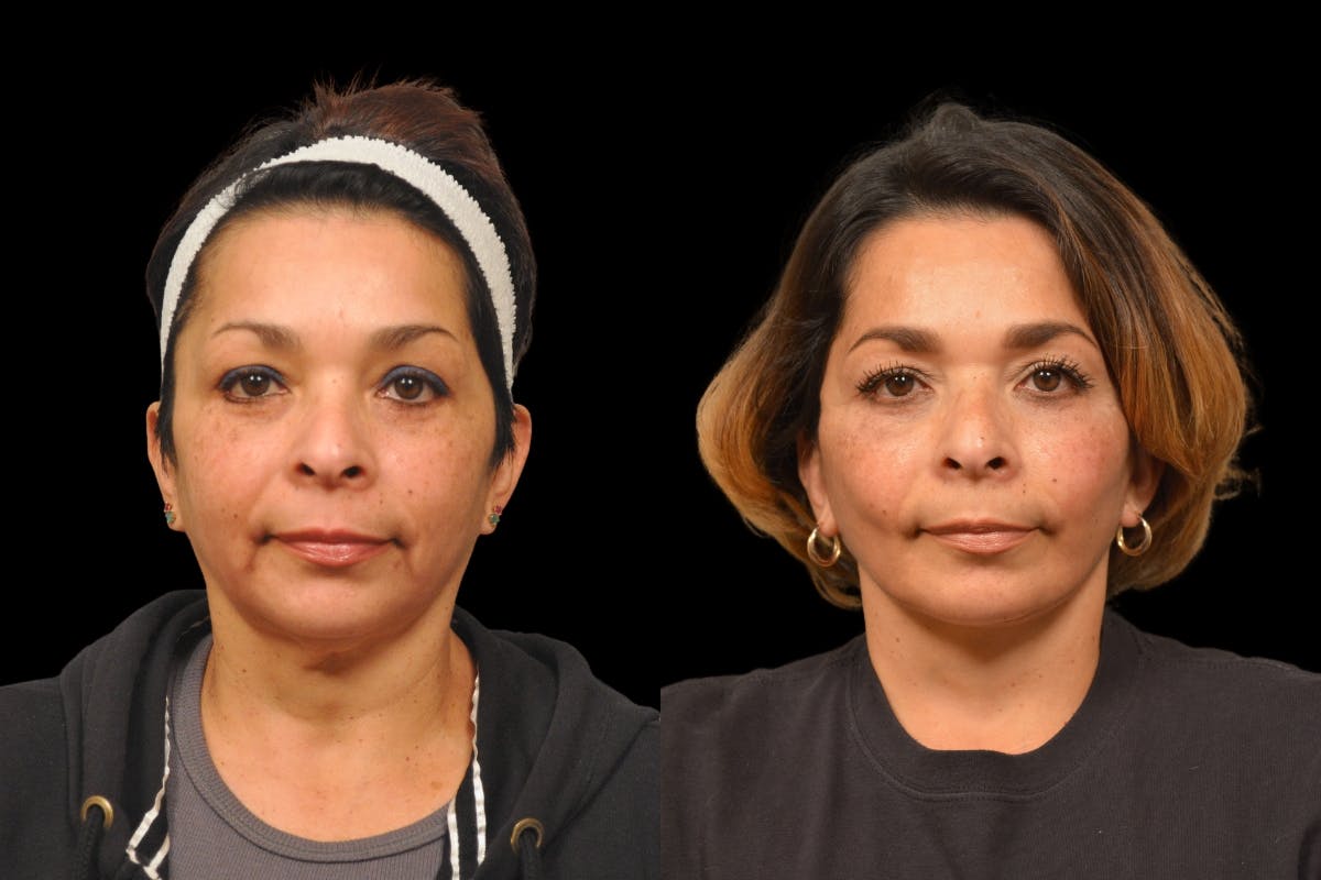 Neck Lift Before & After Gallery - Patient 244418 - Image 2