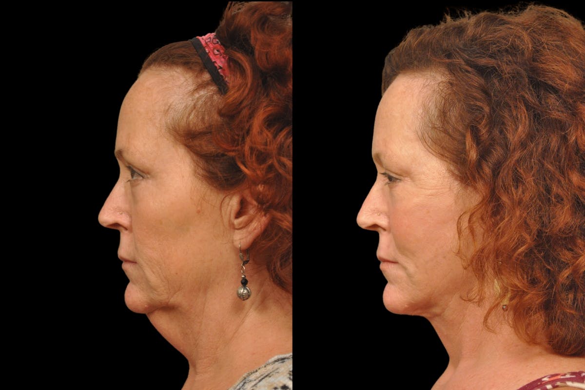 Neck Lift Before & After Gallery - Patient 324866 - Image 2