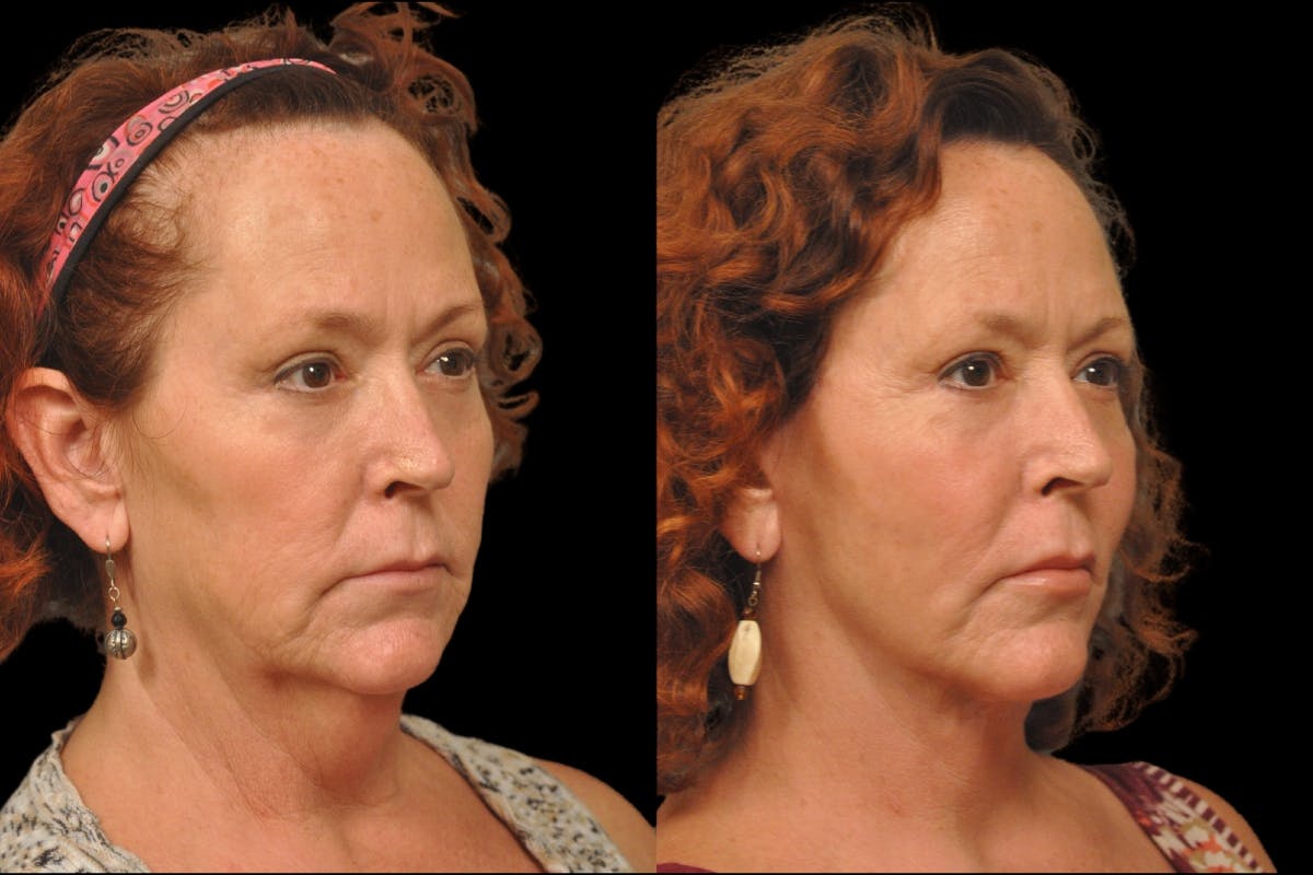 Neck Lift Before & After Gallery - Patient 324866 - Image 3