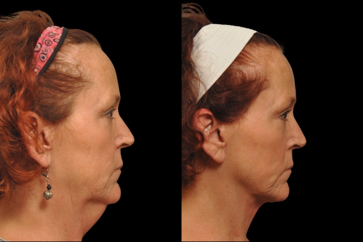 Neck Lift Before & After Gallery - Patient 324866 - Image 4