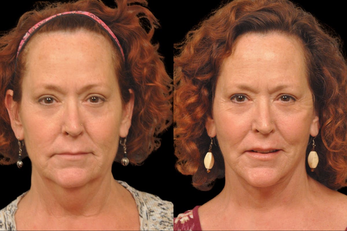 Neck Lift Before & After Gallery - Patient 324866 - Image 5