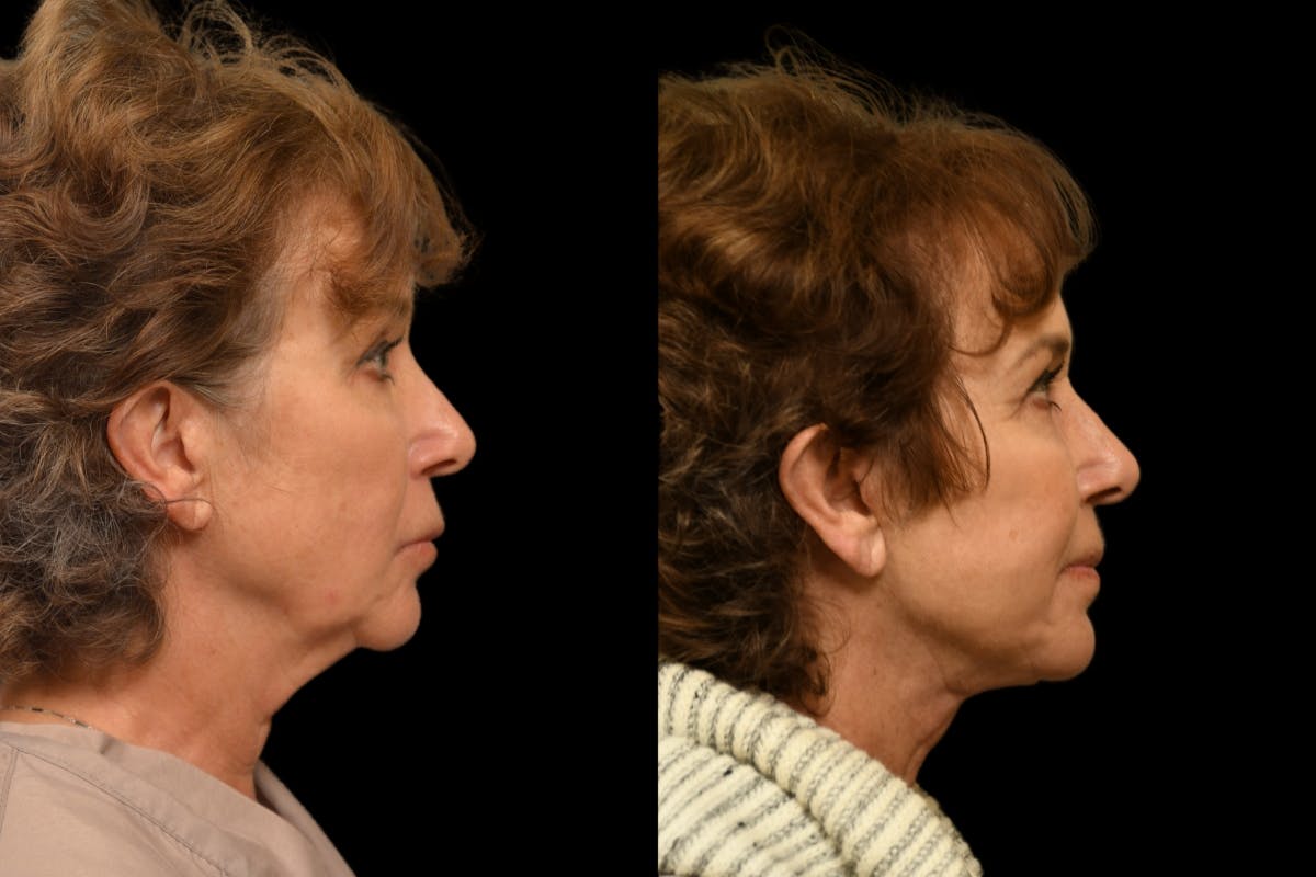 Chin Augmentation Before & After Gallery - Patient 125914 - Image 4