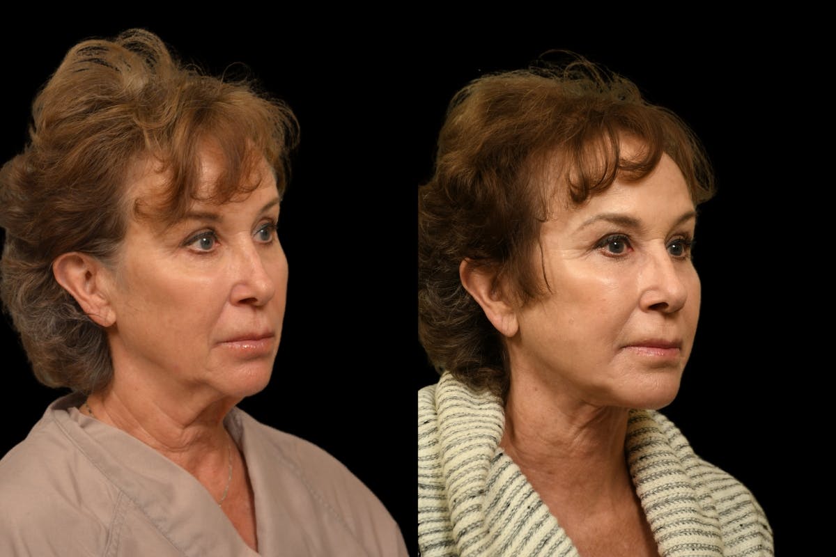 Chin Augmentation Before & After Gallery - Patient 125914 - Image 5