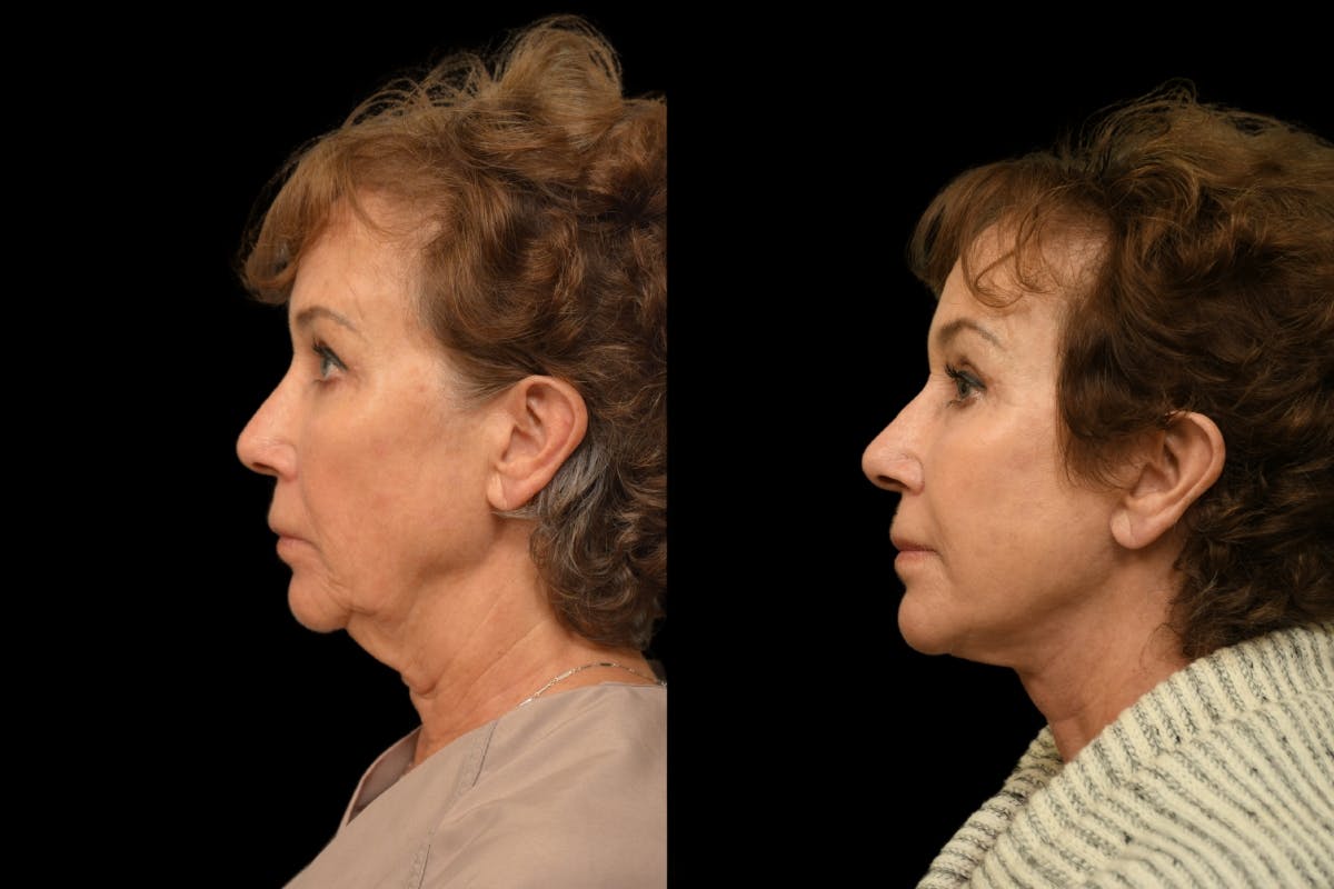 Chin Augmentation Before & After Gallery - Patient 125914 - Image 2