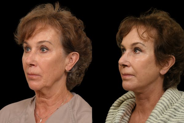 Chin Augmentation Before & After Gallery - Patient 125914 - Image 1