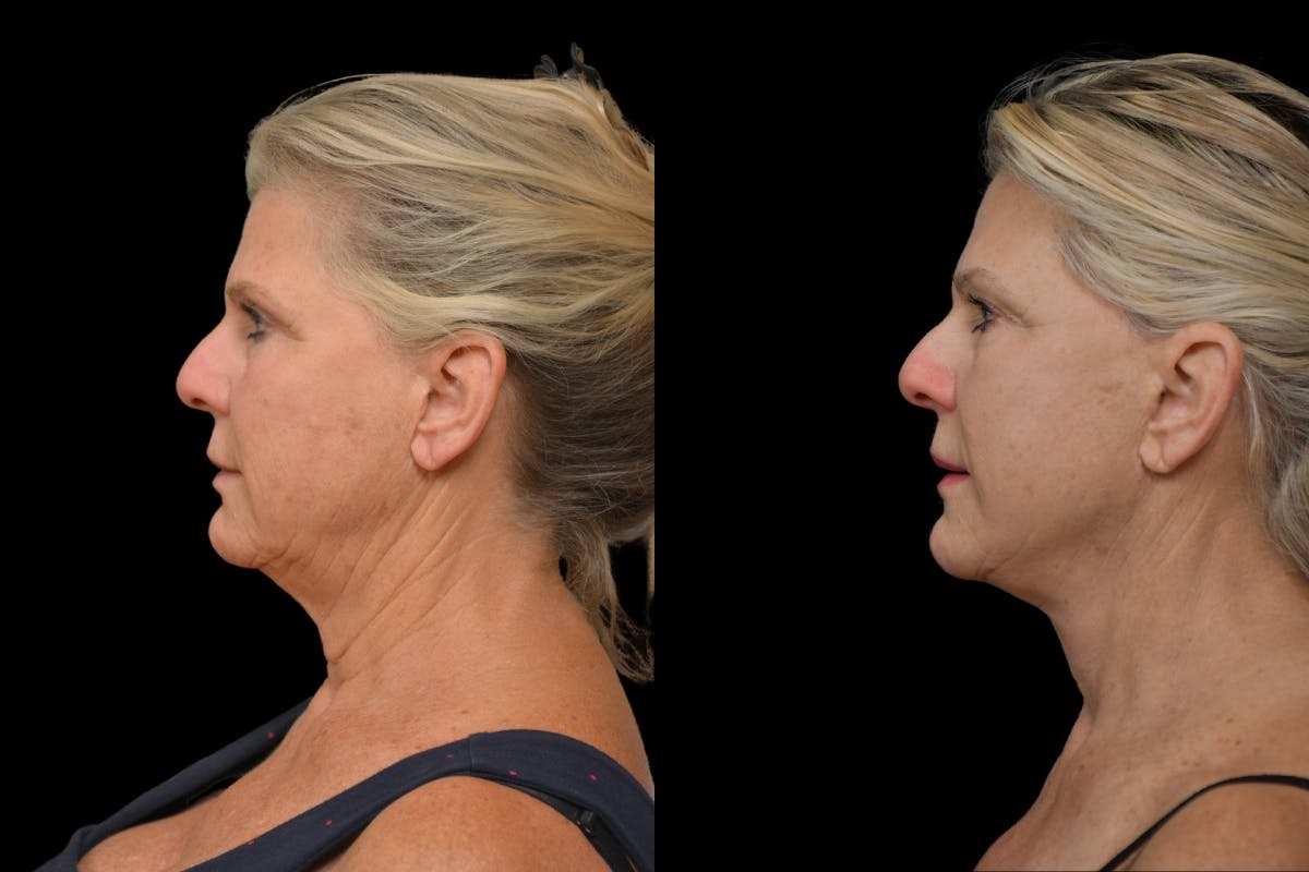 Neck Lift Before & After Gallery - Patient 358926 - Image 2