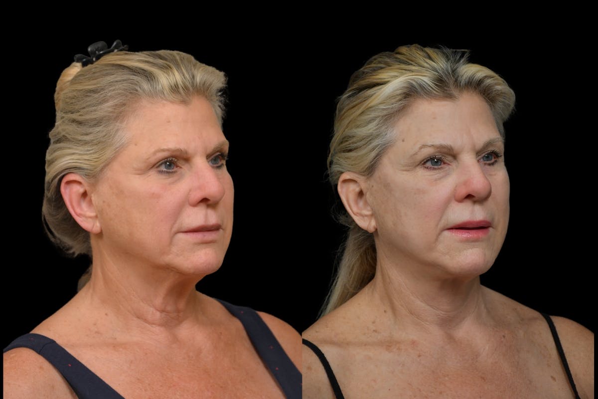 Neck Lift Before & After Gallery - Patient 358926 - Image 3