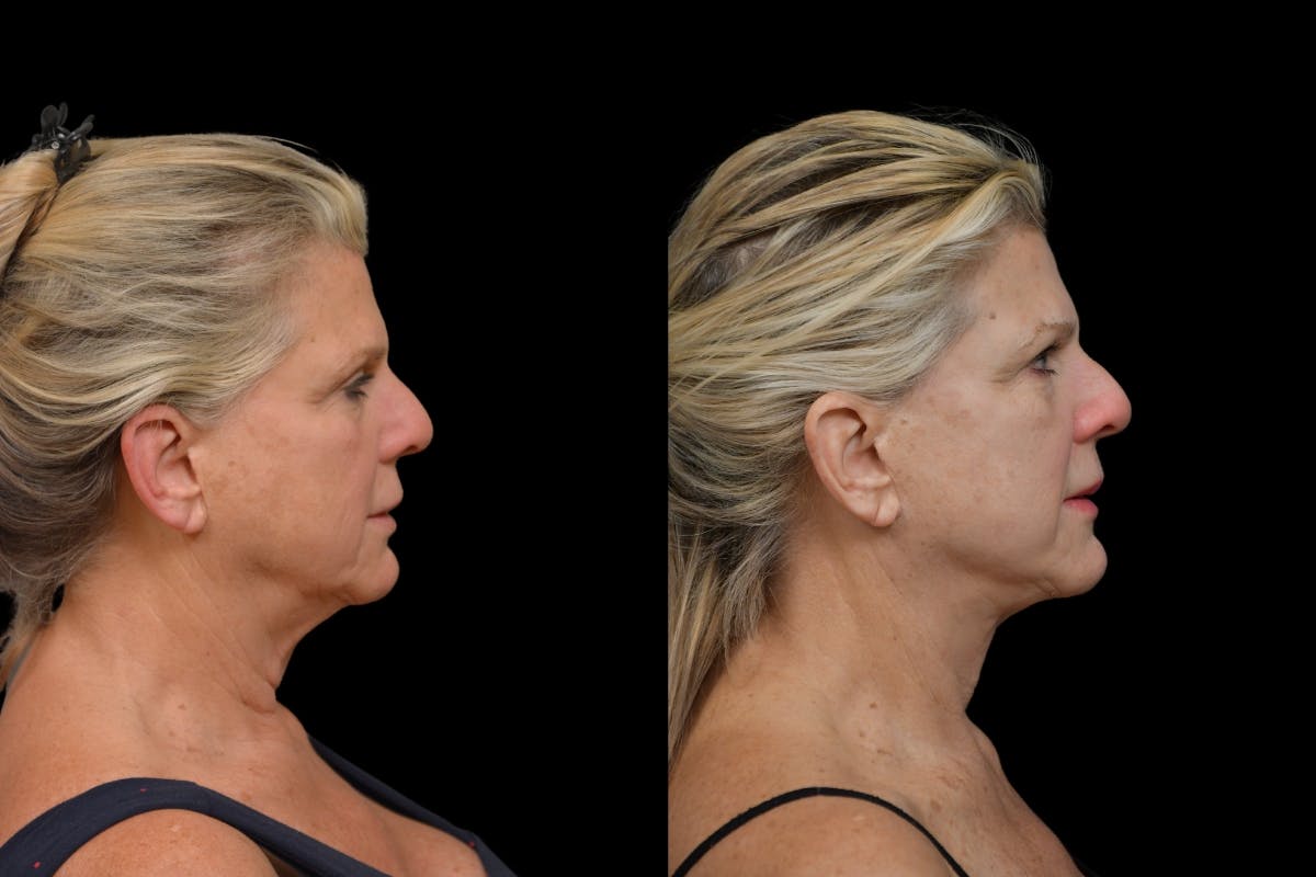 Neck Lift Before & After Gallery - Patient 358926 - Image 4
