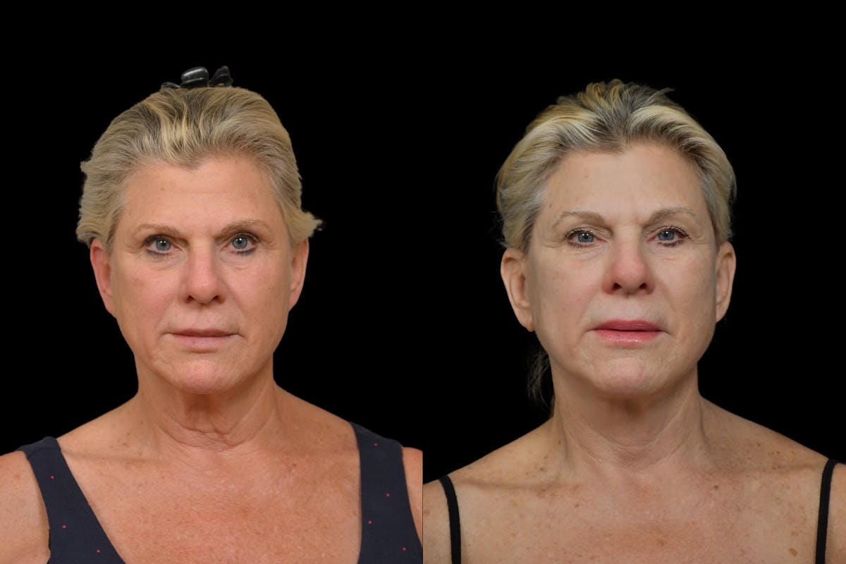 Neck Lift Before & After Gallery - Patient 358926 - Image 5