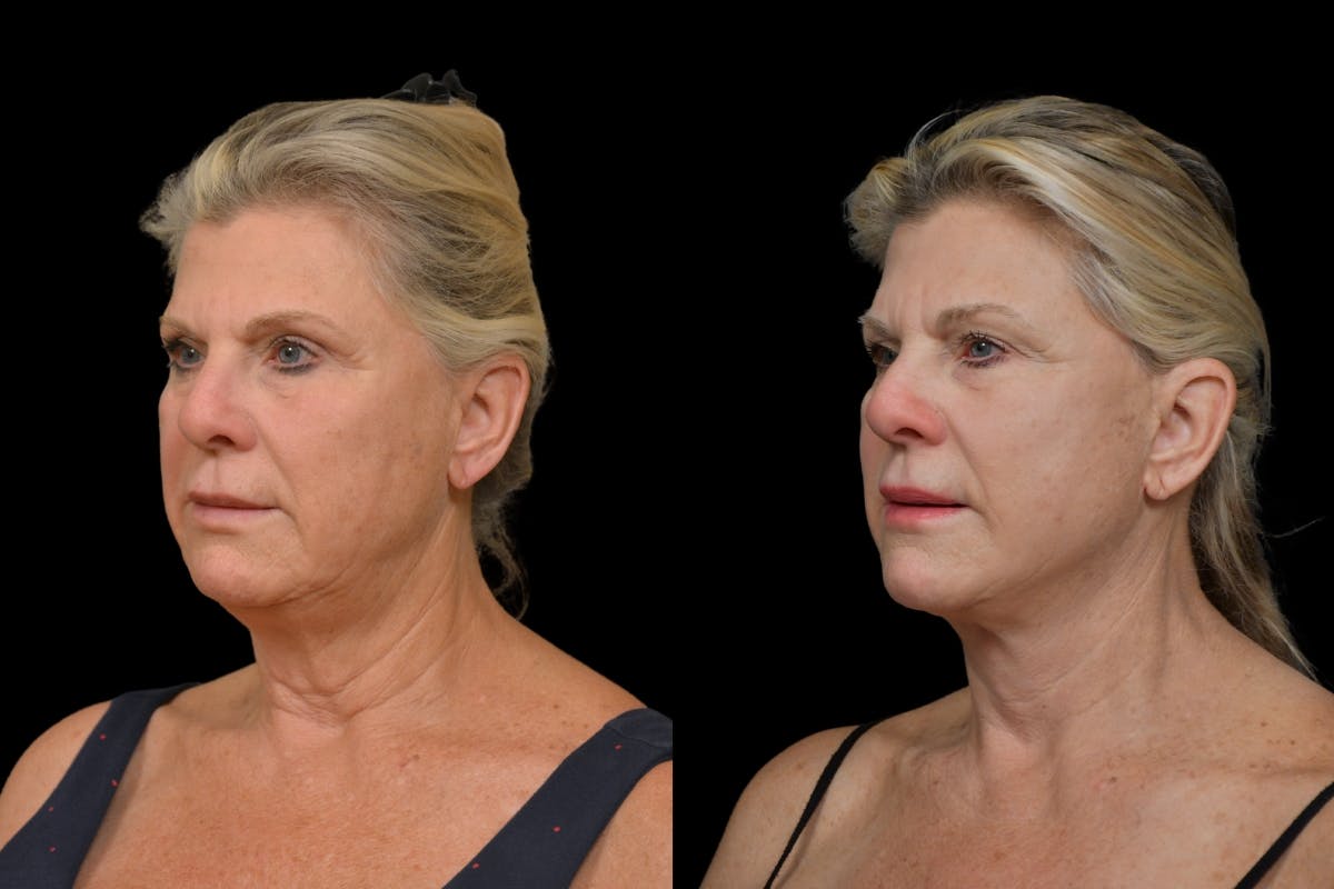 Neck Lift Before & After Gallery - Patient 358926 - Image 1
