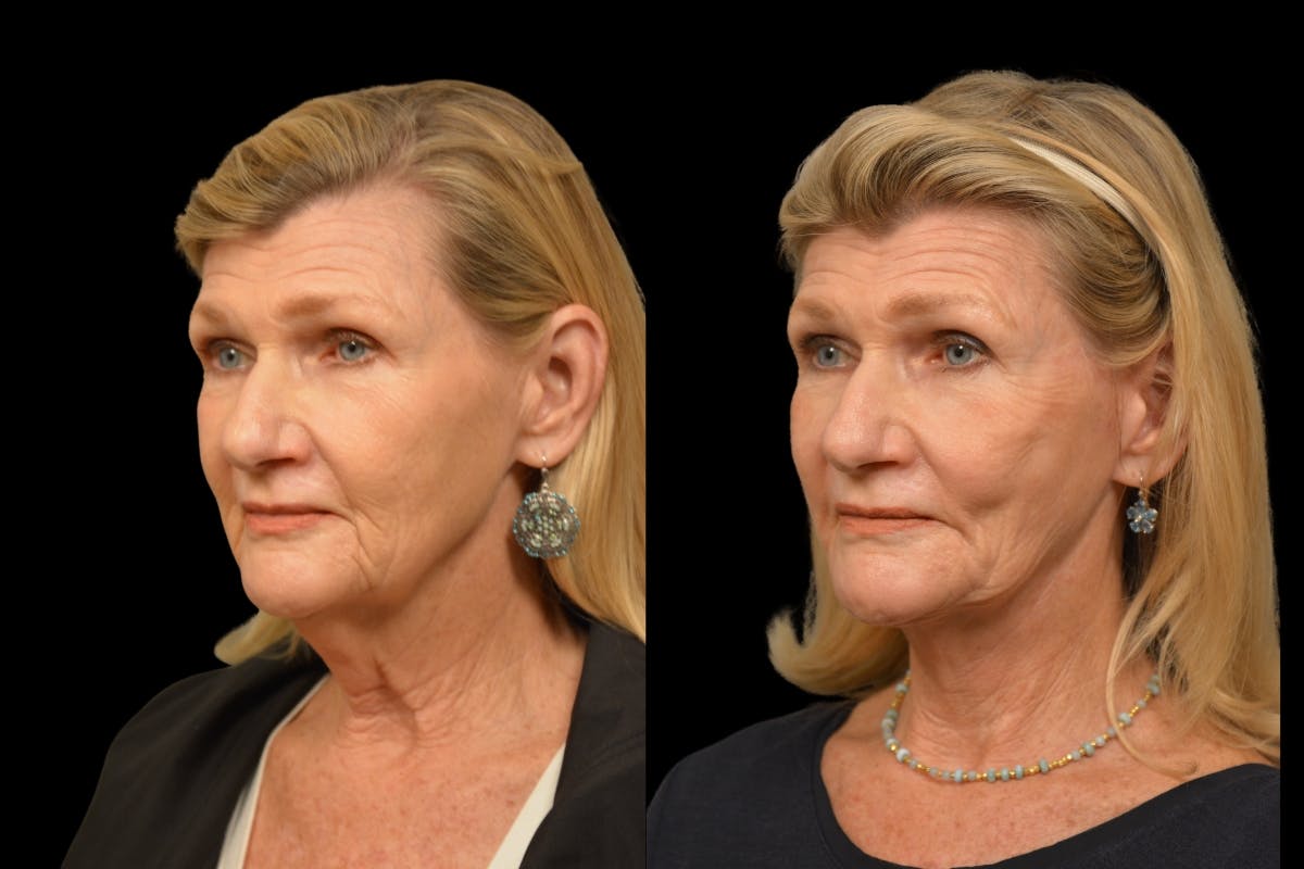 Neck Lift Before & After Gallery - Patient 329907 - Image 1