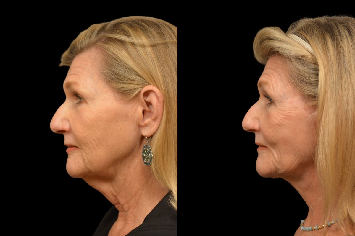 Neck Lift Before & After Gallery - Patient 329907 - Image 2