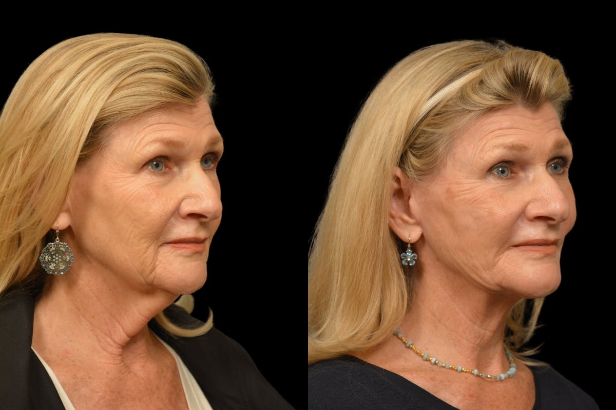 Neck Lift Before & After Gallery - Patient 329907 - Image 3