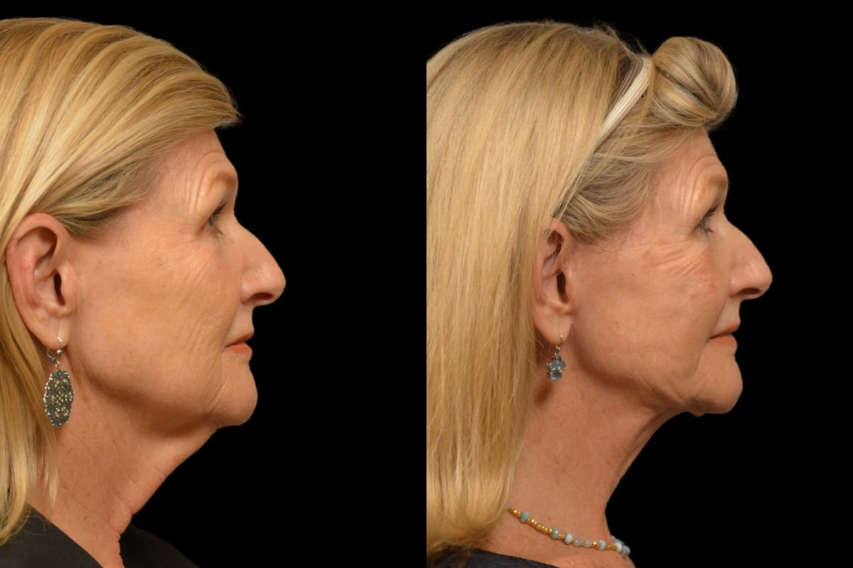Neck Lift Before & After Gallery - Patient 329907 - Image 4