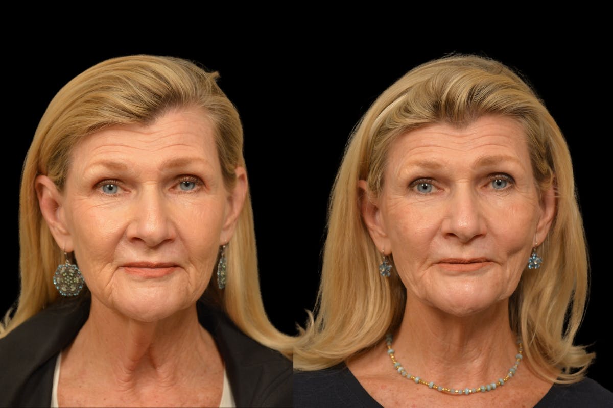 Neck Lift Before & After Gallery - Patient 329907 - Image 5