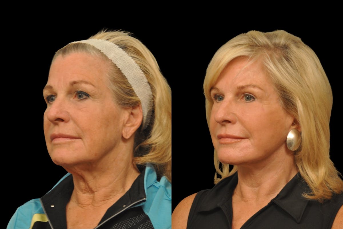 Neck Lift Before & After Gallery - Patient 656972 - Image 1