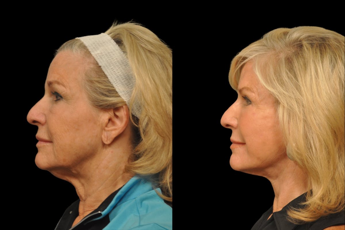 Neck Lift Before & After Gallery - Patient 656972 - Image 2