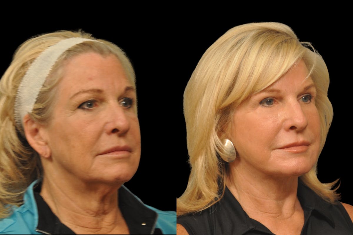 Neck Lift Before & After Gallery - Patient 656972 - Image 3
