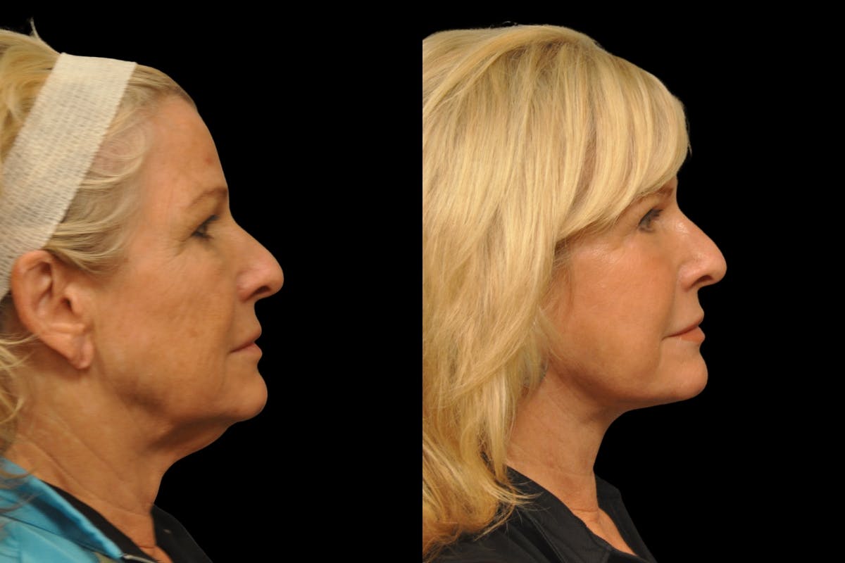 Neck Lift Before & After Gallery - Patient 656972 - Image 4