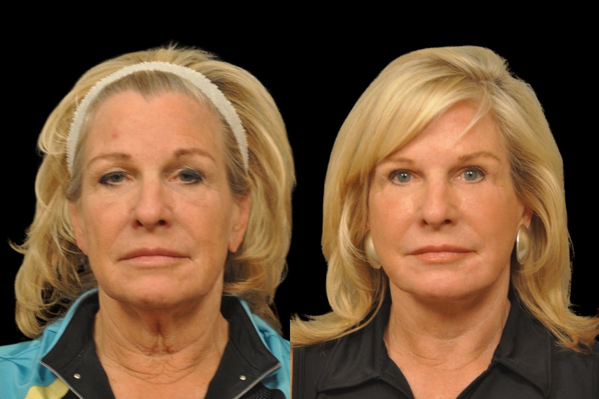 Neck Lift Before & After Gallery - Patient 656972 - Image 5