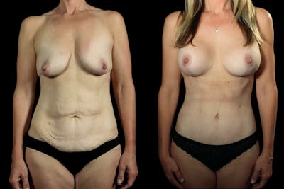 Mommy Makeover Before & After Gallery - Patient 115526 - Image 1