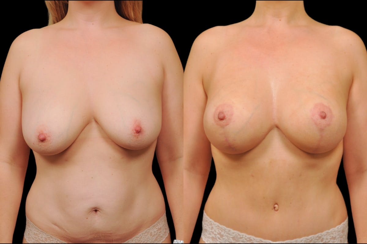 Mommy Makeover Before & After Gallery - Patient 227087 - Image 1