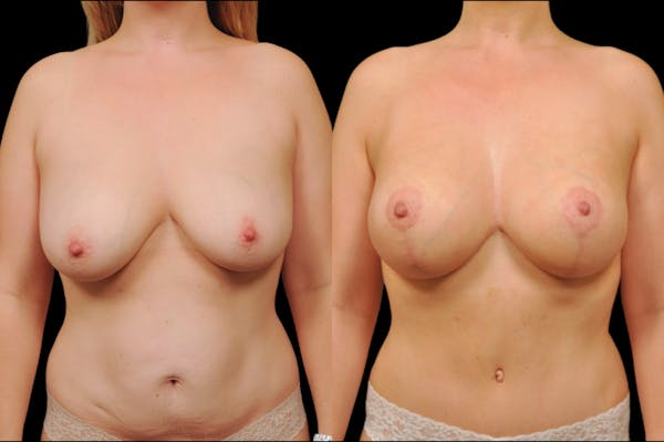 Mommy Makeover Before & After Gallery - Patient 227087 - Image 1