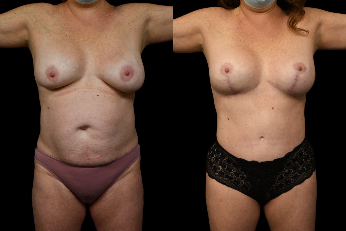 Mommy Makeover Before & After Gallery - Patient 446726 - Image 1