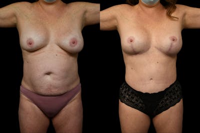 Tummy Tuck Before & After Gallery - Patient 267771 - Image 1