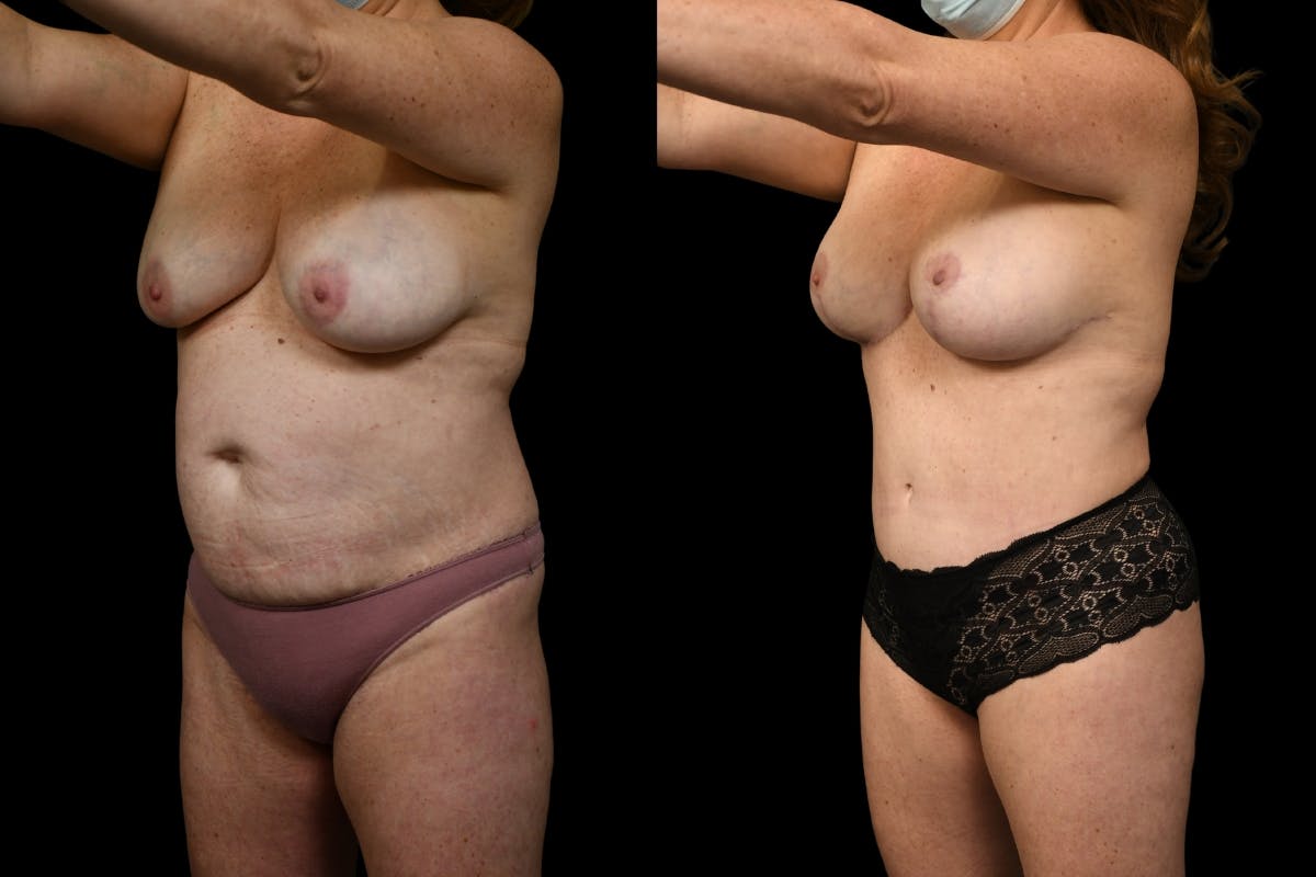 Mommy Makeover Before & After Gallery - Patient 446726 - Image 2