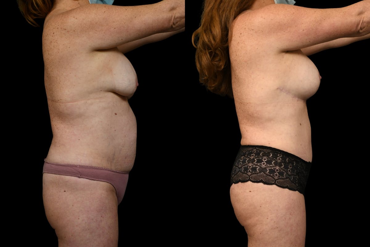 Mommy Makeover Before & After Gallery - Patient 446726 - Image 5