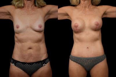 Tummy Tuck Before & After Gallery - Patient 542761 - Image 1